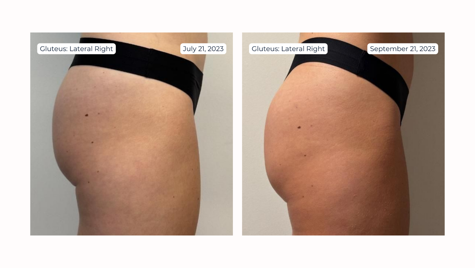 Non-Surgical BBL Practitioner Training Guide and Forms
